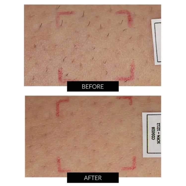Alles SMOOTHSKIN uređaj za uklanjanje dlačica PURE FIT IPL